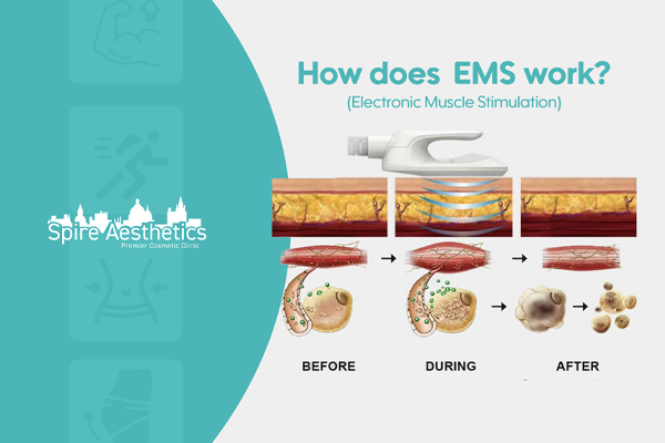 EMS treatment for post pregnancy weight loss treatment Sparkhill