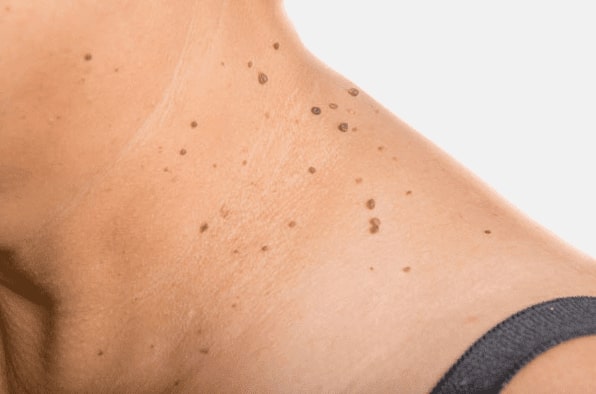 Are you looking for easy skin tag removal Sparkhill - then contact Spire today!